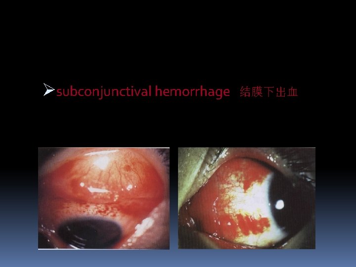 Øsubconjunctival hemorrhage 结膜下出血 