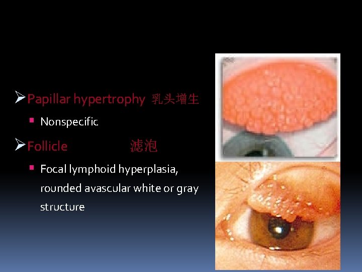 ØPapillar hypertrophy 乳头增生 Nonspecific ØFollicle 滤泡 Focal lymphoid hyperplasia, rounded avascular white or gray