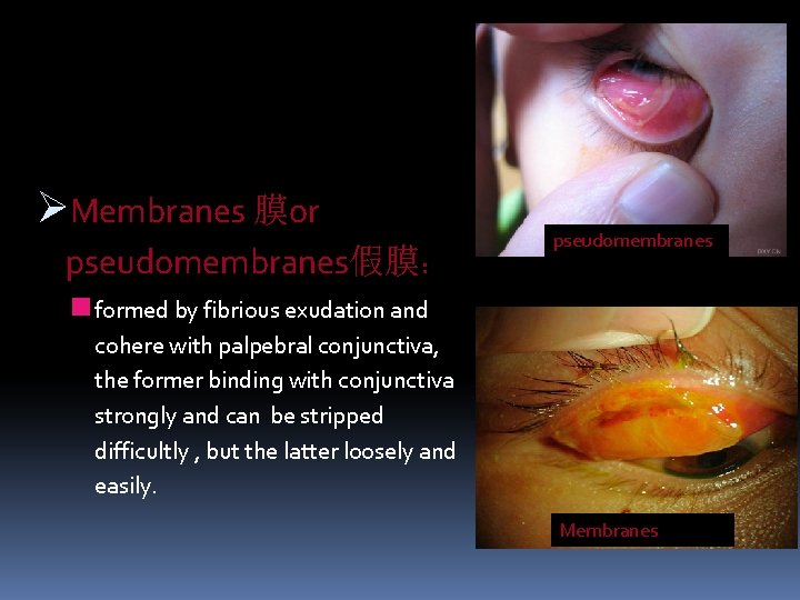 ØMembranes 膜or pseudomembranes假膜： pseudomembranes n formed by fibrious exudation and cohere with palpebral conjunctiva,