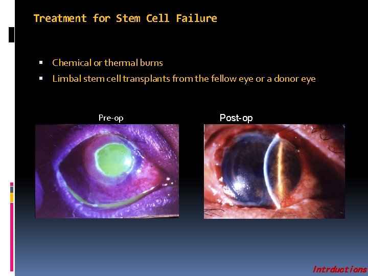 Treatment for Stem Cell Failure Chemical or thermal burns Limbal stem cell transplants from