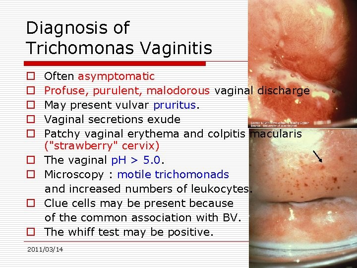 Diagnosis of Trichomonas Vaginitis o o o o o Often asymptomatic Profuse, purulent, malodorous