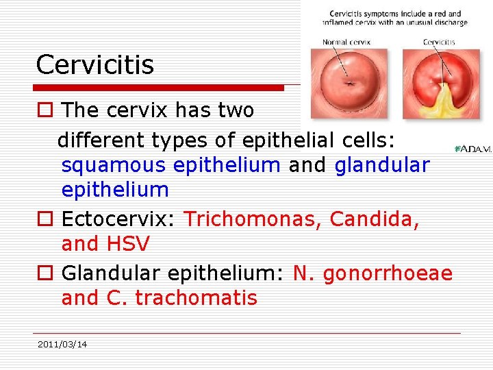 Cervicitis o The cervix has two different types of epithelial cells: squamous epithelium and