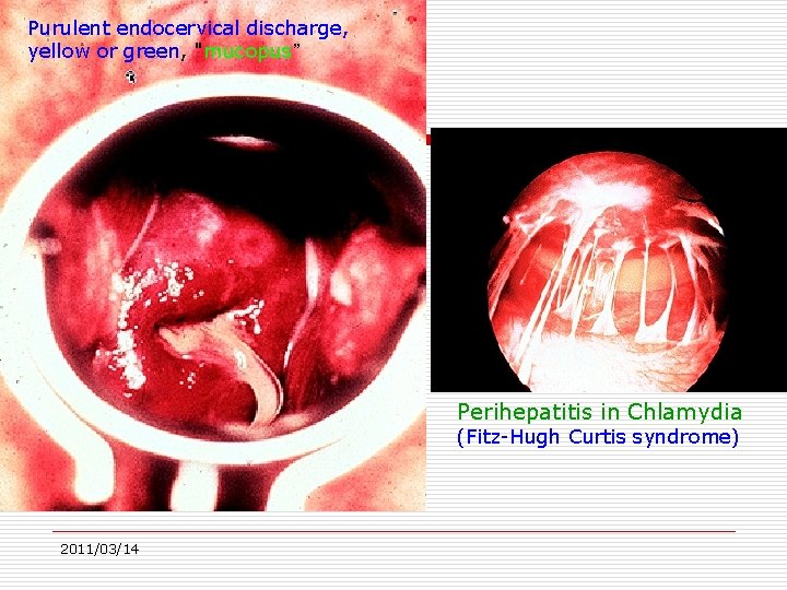 Purulent endocervical discharge, yellow or green, "mucopus” Perihepatitis in Chlamydia (Fitz-Hugh Curtis syndrome) 2011/03/14