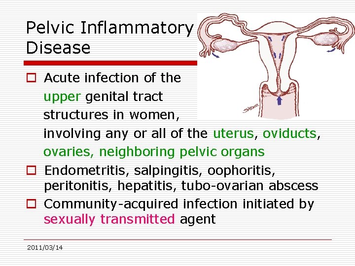 Pelvic Inflammatory Disease o Acute infection of the upper genital tract structures in women,