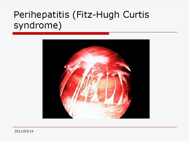 Perihepatitis (Fitz-Hugh Curtis syndrome) 2011/03/14 