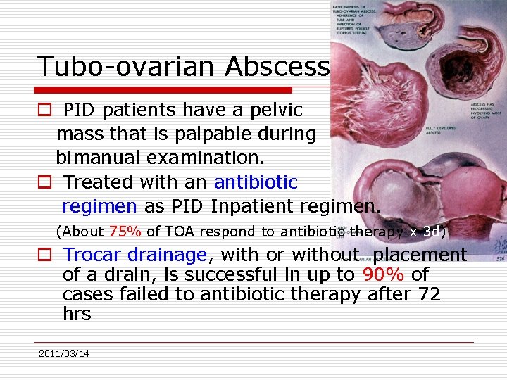 Tubo-ovarian Abscess o PID patients have a pelvic mass that is palpable during bimanual