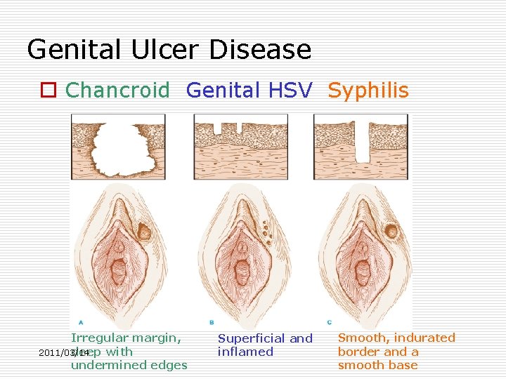 Genital Ulcer Disease o Chancroid Genital HSV Syphilis Irregular margin, deep with 2011/03/14 undermined