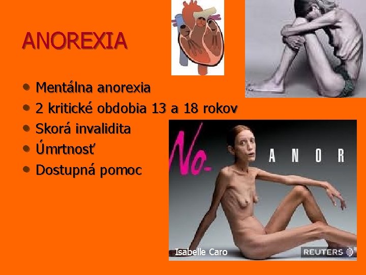 ANOREXIA • Mentálna anorexia • 2 kritické obdobia 13 a 18 rokov • Skorá