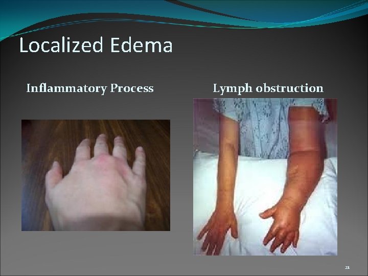 Localized Edema Inflammatory Process Lymph obstruction 21 