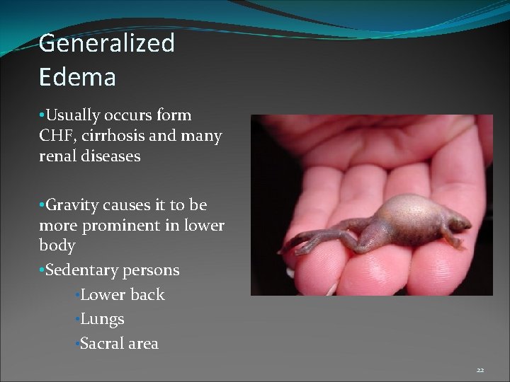 Generalized Edema • Usually occurs form CHF, cirrhosis and many renal diseases • Gravity