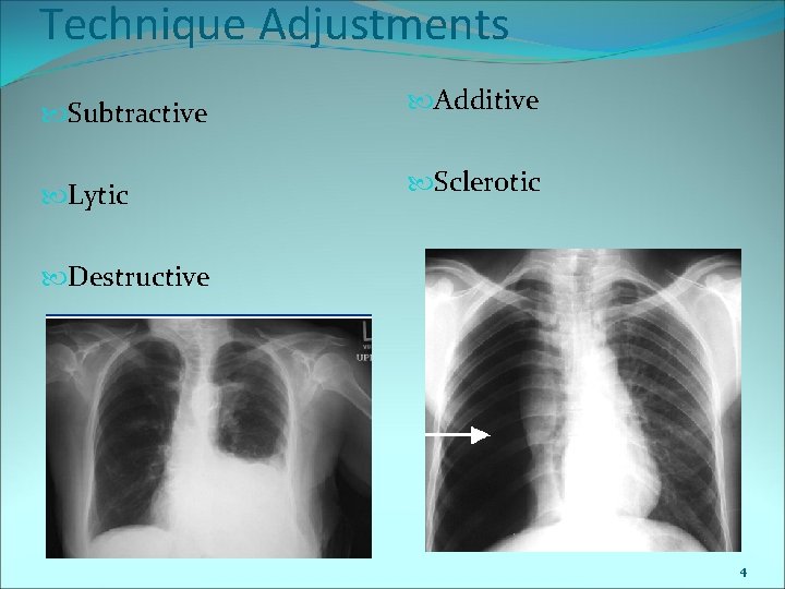 Technique Adjustments Subtractive Additive Lytic Sclerotic Destructive 4 