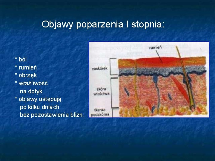 Objawy poparzenia I stopnia: * ból * rumień * obrzęk * wrażliwość na dotyk