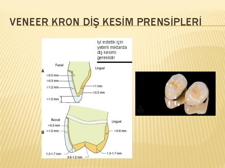 VENEER KRON DİŞ KESİM PRENSİPLERİ İyi estetik için yeterli miktarda diş kesimi gereklidir 
