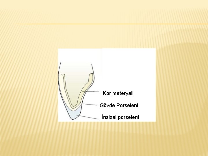 Kor materyali Gövde Porseleni İnsizal porseleni 