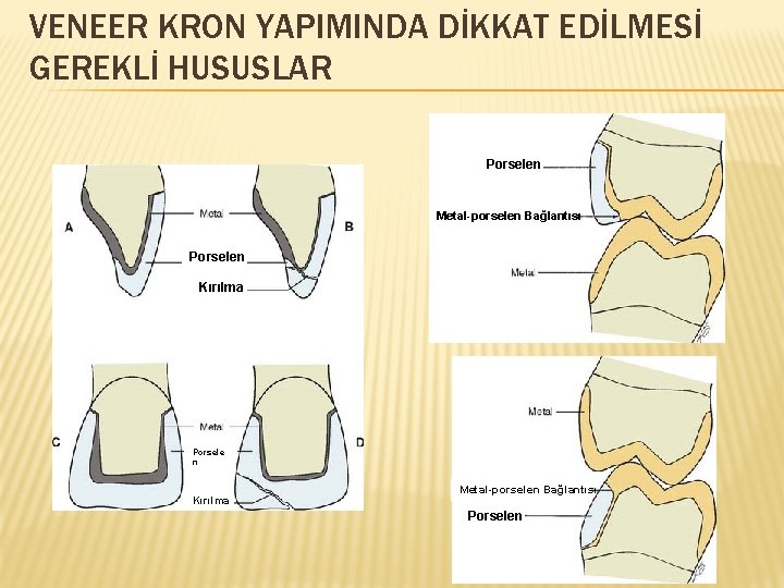VENEER KRON YAPIMINDA DİKKAT EDİLMESİ GEREKLİ HUSUSLAR Porselen Metal-porselen Bağlantısı Porselen Kırılma Porsele n