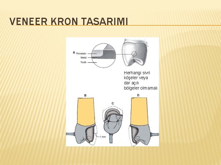 VENEER KRON TASARIMI Herhangi sivri köşeler veya dar açılı bölgeler olmamalı 