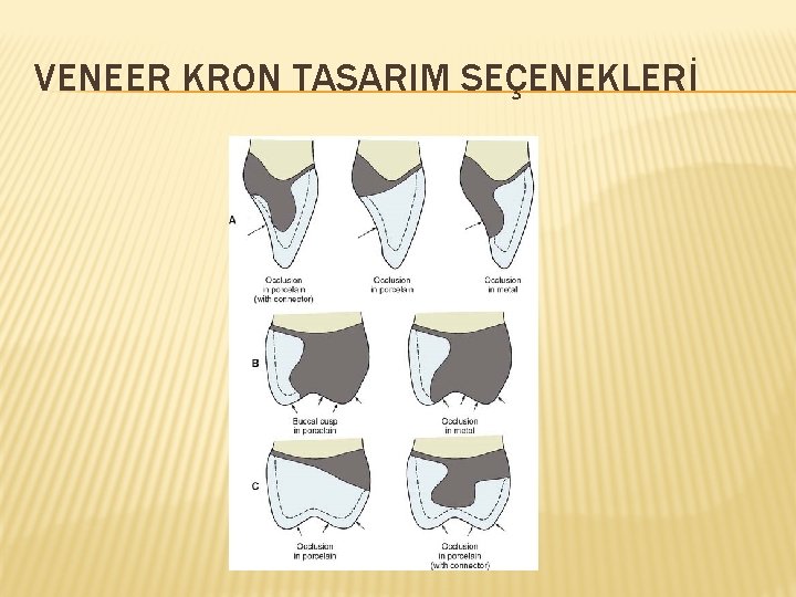 VENEER KRON TASARIM SEÇENEKLERİ 
