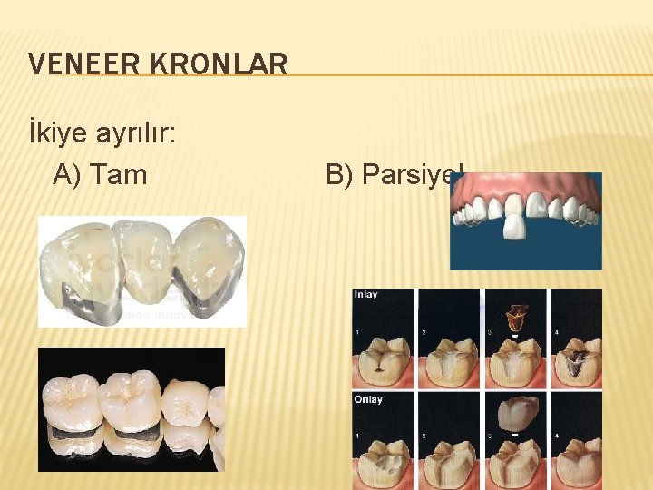 VENEER KRONLAR İkiye ayrılır: A) Tam B) Parsiyel 