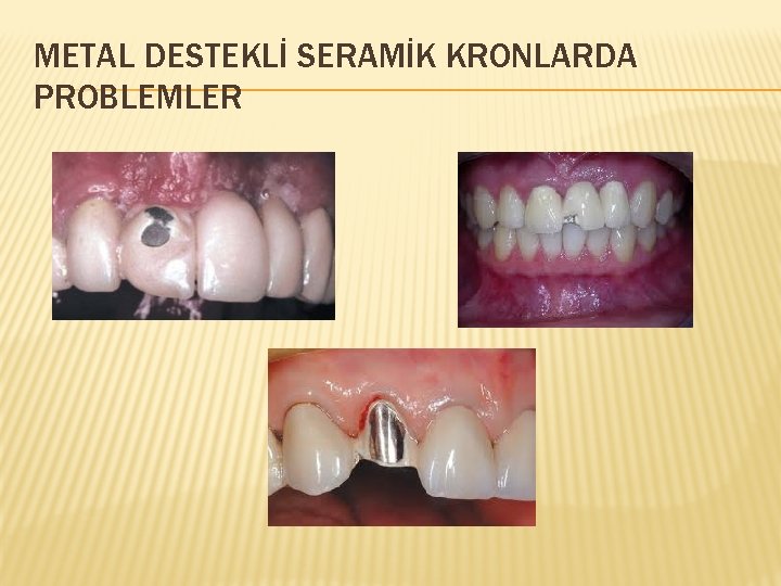 METAL DESTEKLİ SERAMİK KRONLARDA PROBLEMLER 