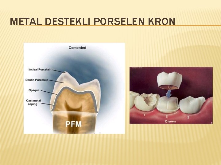 METAL DESTEKLI PORSELEN KRON 