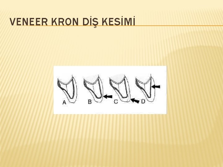 VENEER KRON DİŞ KESİMİ 