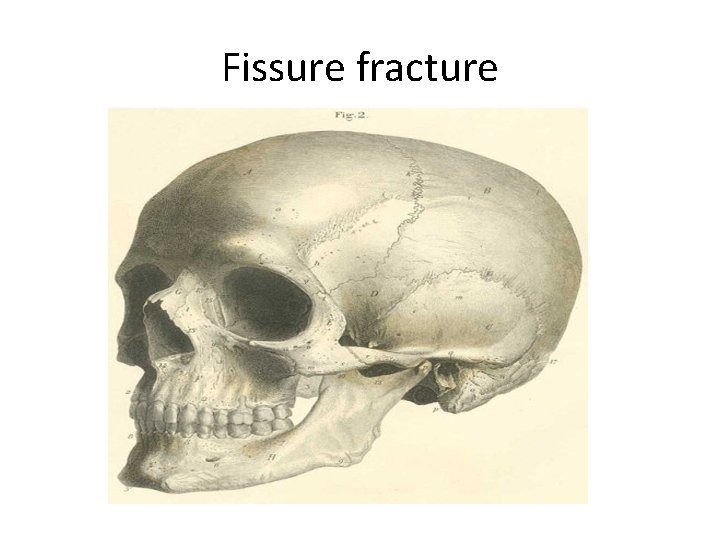 Fissure fracture 
