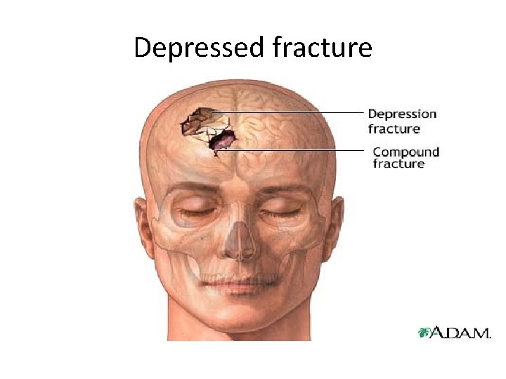 Depressed fracture 