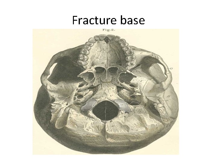 Fracture base 