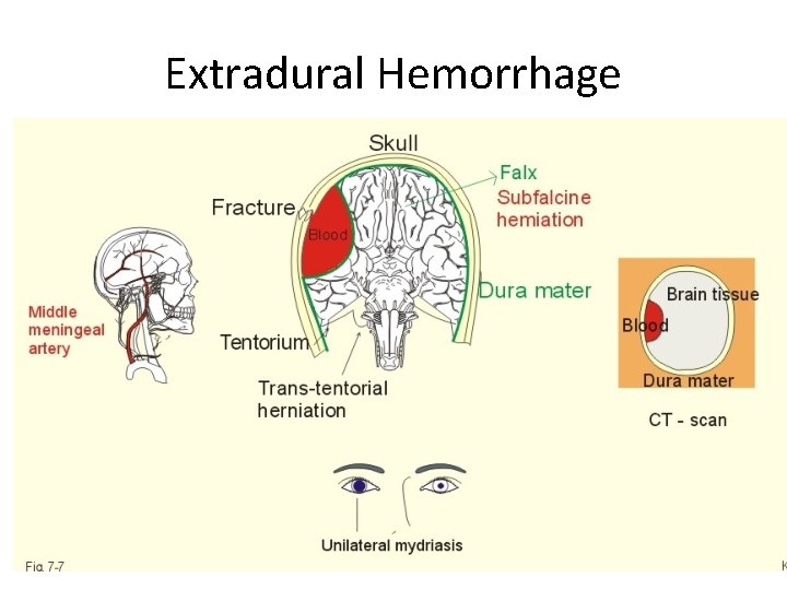 Extradural Hemorrhage 