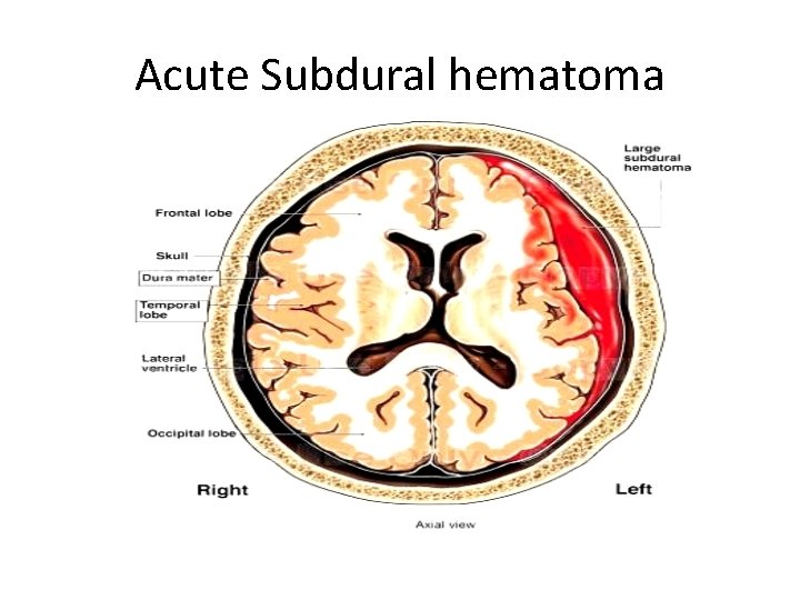 Acute Subdural hematoma 