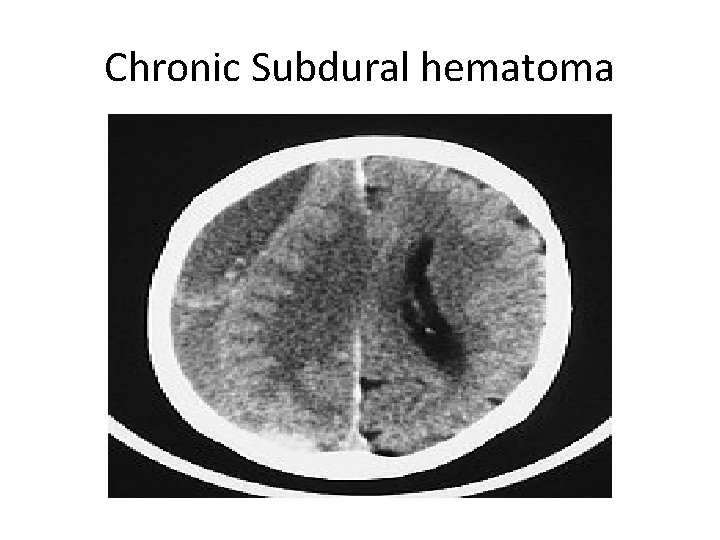 Chronic Subdural hematoma 