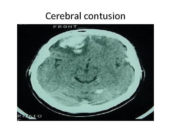 Cerebral contusion 