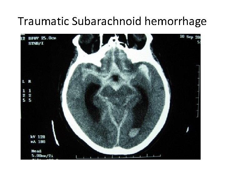 Traumatic Subarachnoid hemorrhage 