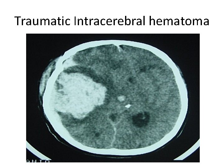 Traumatic Intracerebral hematoma 