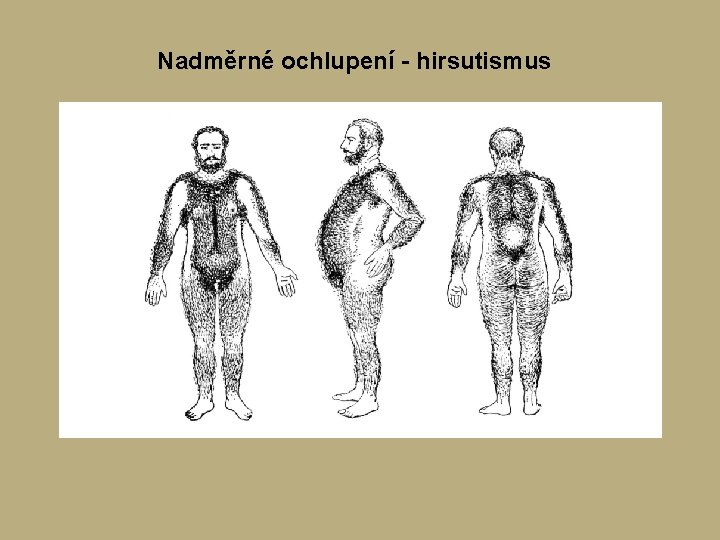 Nadměrné ochlupení - hirsutismus Nadměrné ochlupení - hirsutismus