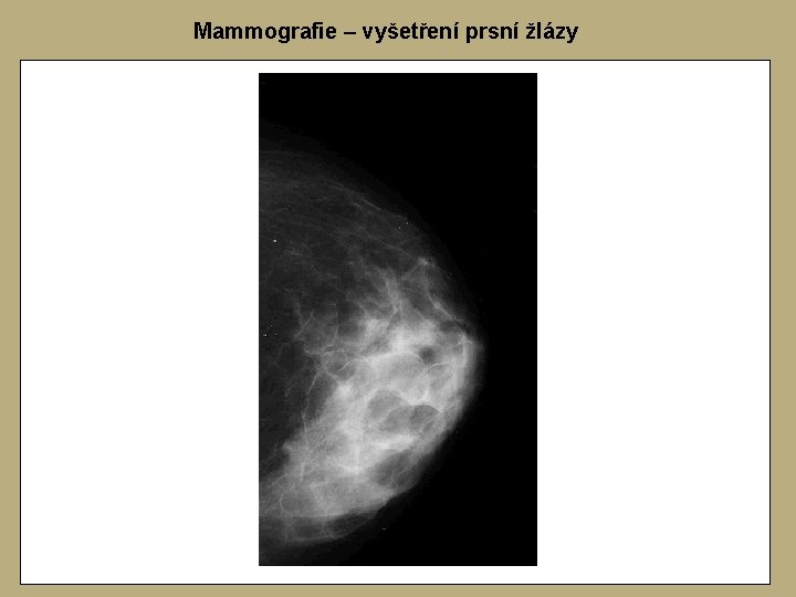 Mammografie – vyšetření prsní žlázy Mammografie – vyšetření prsní žlázy
