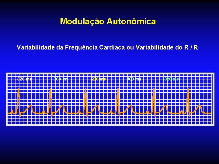 Modulação Autonômica Variabilidade da Frequência Cardíaca ou Variabilidade do R / R 320 ms