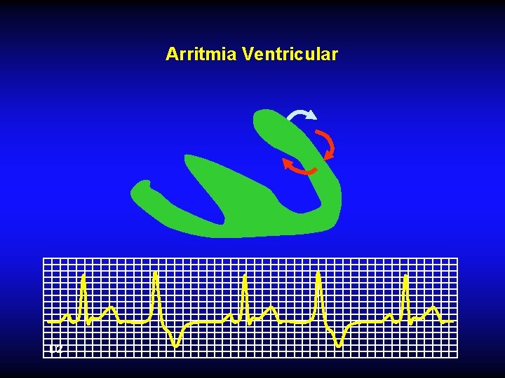 Arritmia Ventricular D 2 Arritmia Ventricular D 2