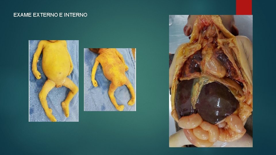 EXAME EXTERNO E INTERNO 