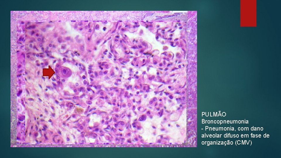 PULMÃO Broncopneumonia - Pneumonia, com dano alveolar difuso em fase de organização (CMV) 
