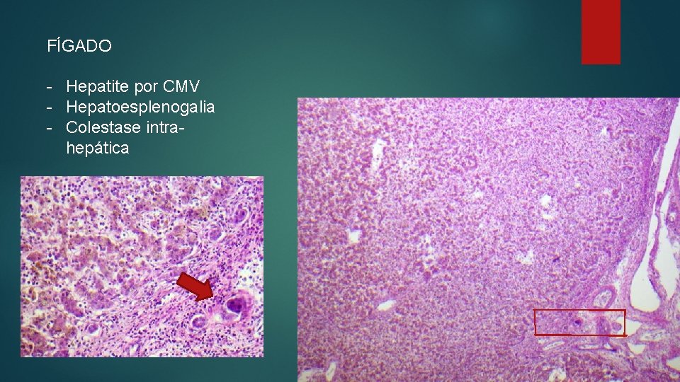 FÍGADO - Hepatite por CMV - Hepatoesplenogalia - Colestase intrahepática 