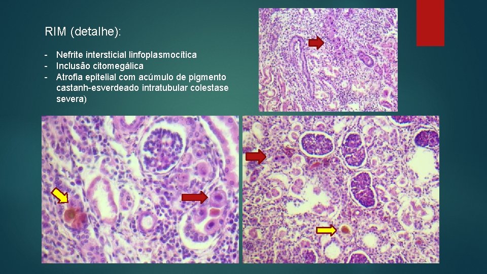 RIM (detalhe): - Nefrite intersticial linfoplasmocítica - Inclusão citomegálica - Atrofia epitelial com acúmulo