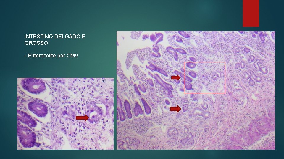INTESTINO DELGADO E GROSSO: - Enterocolite por CMV 