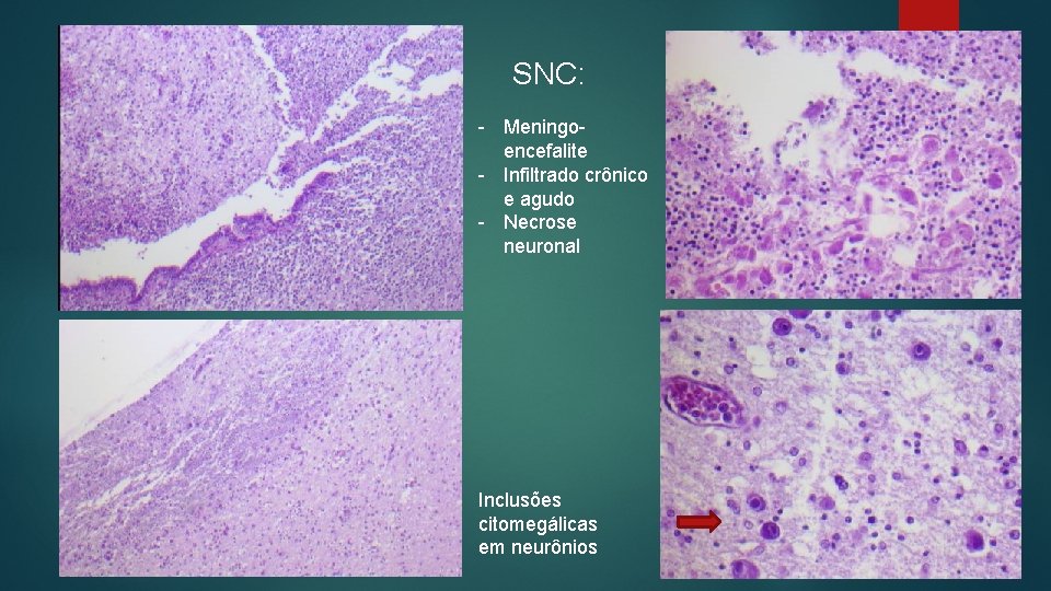 SNC: - Meningoencefalite - Infiltrado crônico e agudo - Necrose neuronal Inclusões citomegálicas em