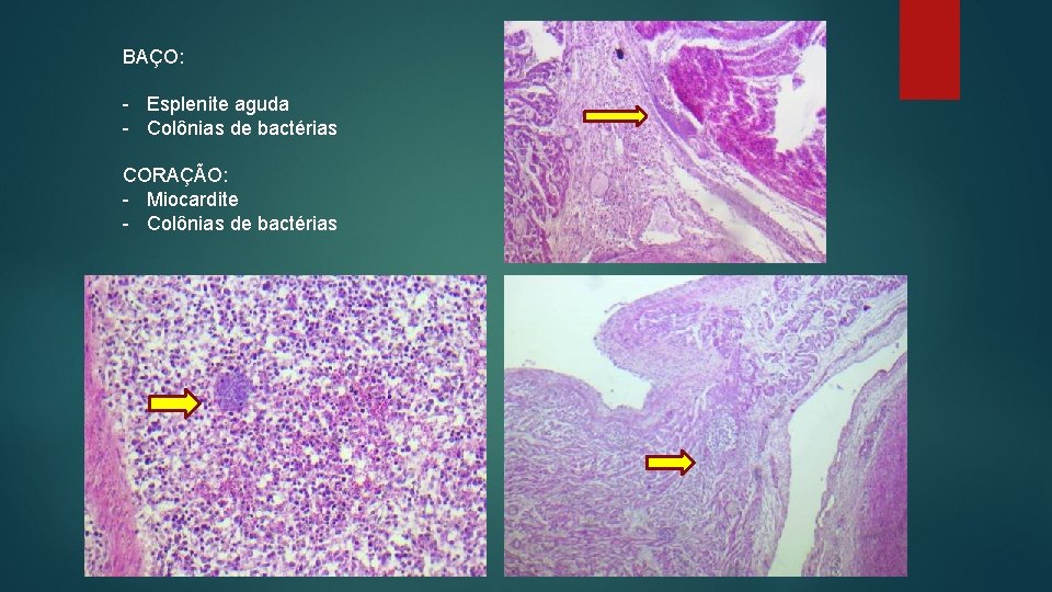 BAÇO: - Esplenite aguda - Colônias de bactérias CORAÇÃO: - Miocardite - Colônias de