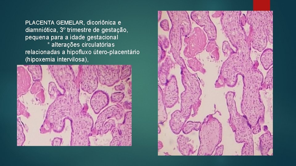 PLACENTA GEMELAR, dicoriônica e diamniótica, 3º trimestre de gestação, pequena para a idade gestacional