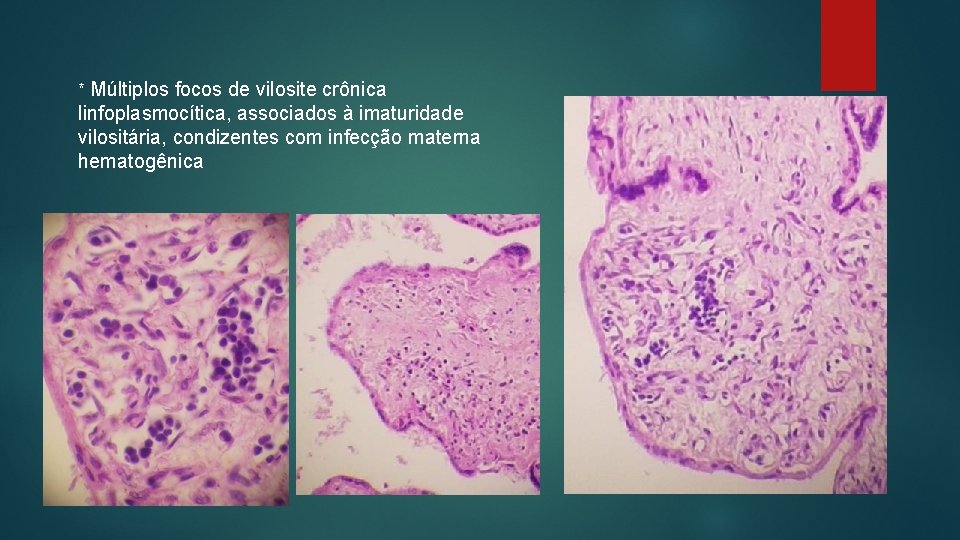 * Múltiplos focos de vilosite crônica linfoplasmocítica, associados à imaturidade vilositária, condizentes com infecção