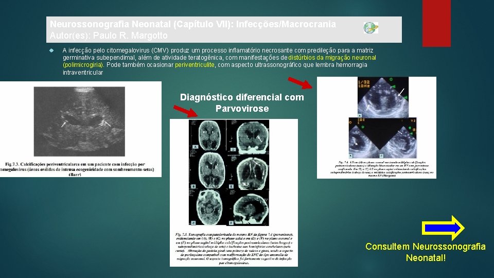Neurossonografia Neonatal (Capítulo VII): Infecções/Macrocrania Autor(es): Paulo R. Margotto A infecção pelo citomegalovirus (CMV)