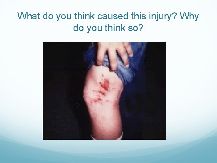 What do you think caused this injury? Why do you think so? 