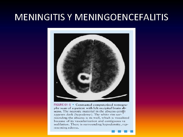 MENINGITIS Y MENINGOENCEFALITIS 